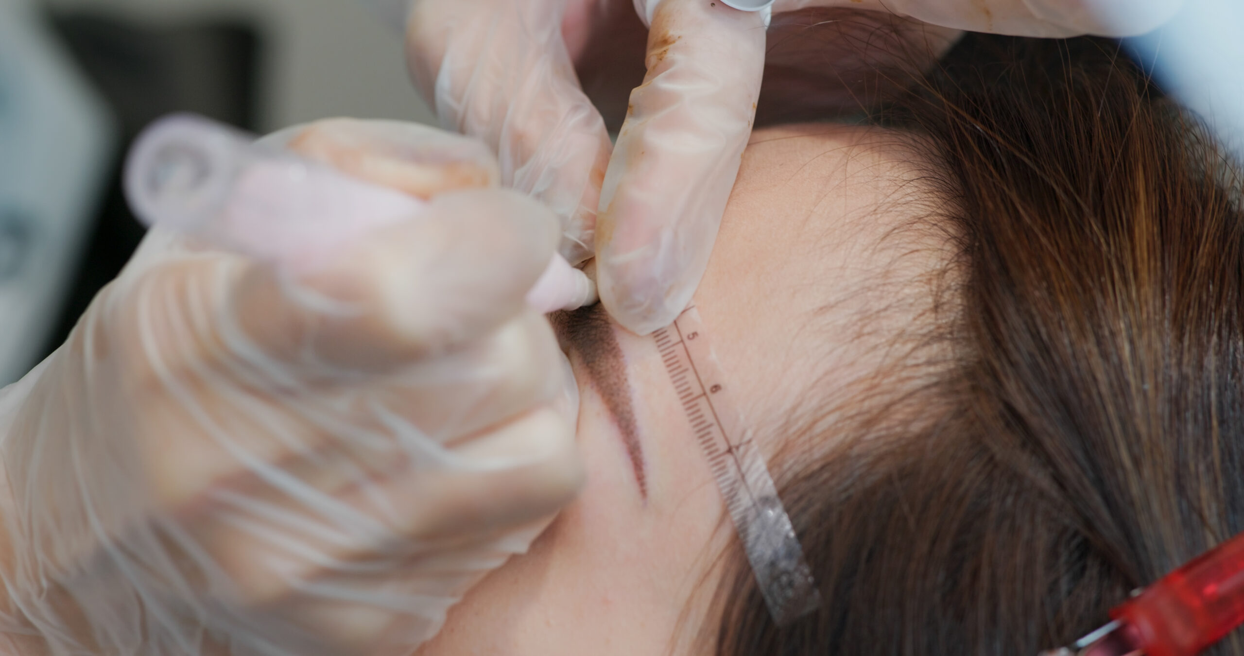 PDO Threads (Polydioxanone Thread Lift)